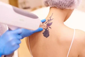 Tattoo Removed