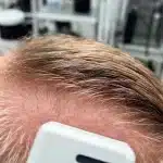 Why Coily Hair May Be the Future of Innovative Hair Transplants