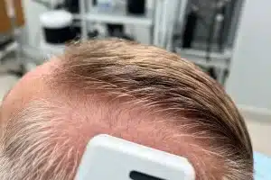 Why Coily Hair May Be the Future of Innovative Hair Transplants