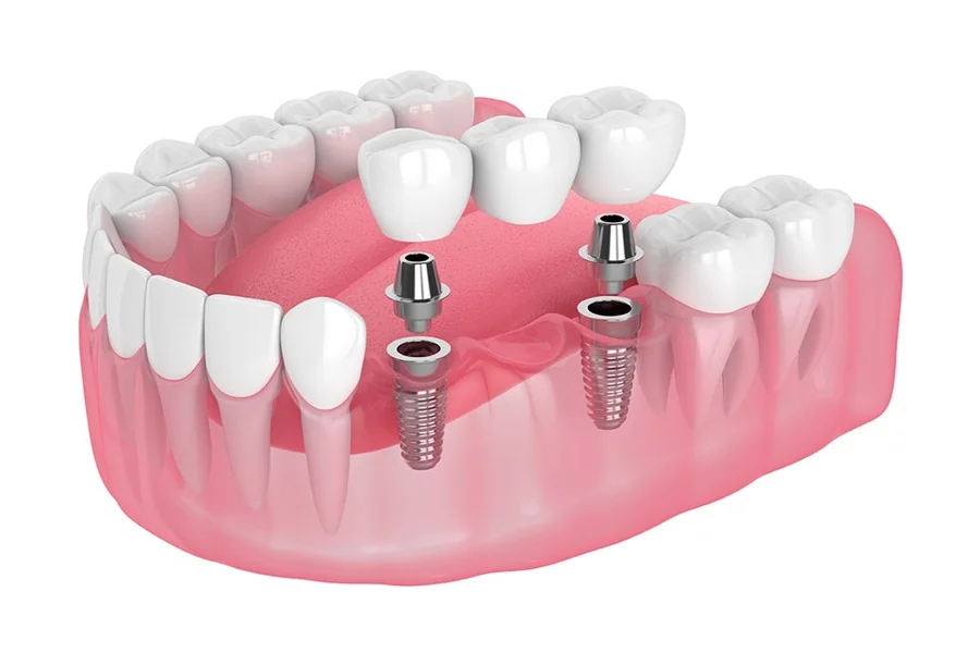 Smile Restoration