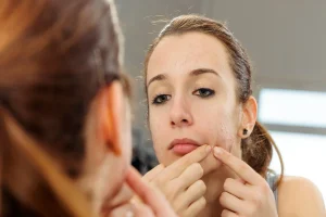 Azelaic Acid for Clearer, Brighter Skin