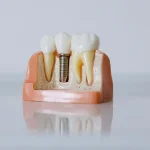 The Benefits of Dental Implants: What You Need to Know Dental Implants