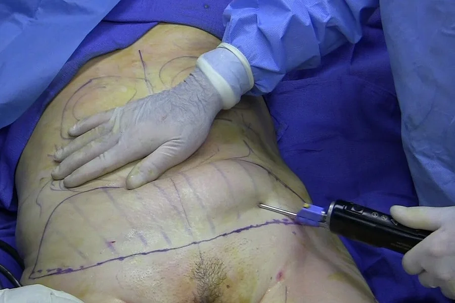 Liposculpture