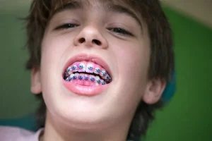 At What Age Should Kids Get Braces A Research-Based Guide for Parents