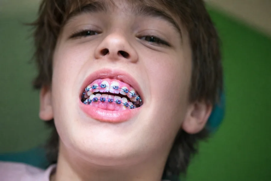 At What Age Should Kids Get Braces A Research-Based Guide for Parents