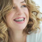 How Long Does Adult Orthodontic Treatment Take? Why Most Cases Last 12–24 Months Adult Orthodontic Treatment